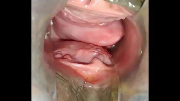 بڑے Prolapse vaginal ٹاپ کلپس