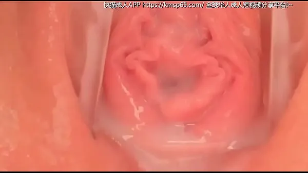 مقاطع vaginal العلوية الكبيرة