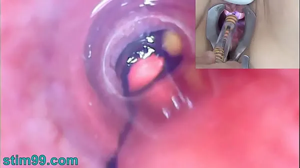 Big Mature Woman Peehole Endoscope Camera in Bladder with Balls top Clips